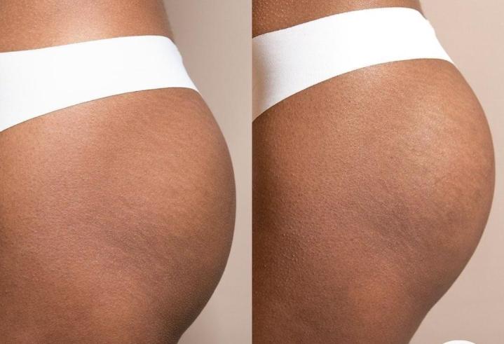 Non-Surgical BBL Miami