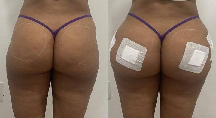 Non-Surgical BBL Miami