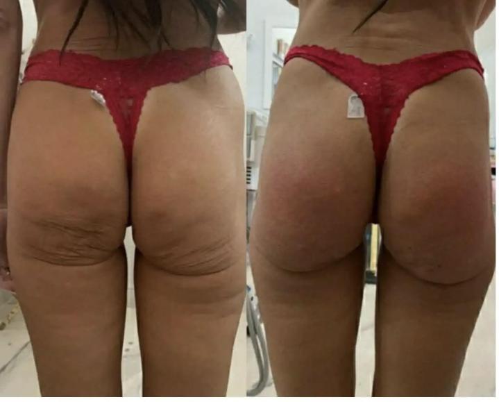 Non-Invasive BBL Miami